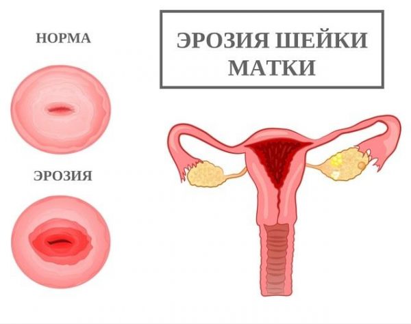 Період скорочення матки після кесаревого розтину: що варто знати?